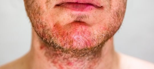 Choroby skóry – najczęstsze dermatozy