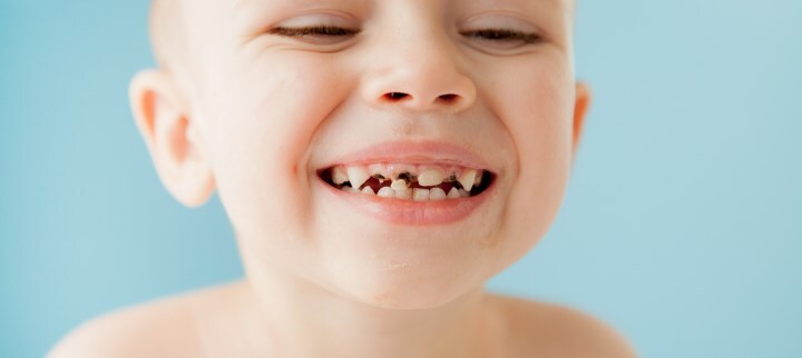 Próchnica zębów - jak powstaje? Zapobieganie i leczenie próchnicy
